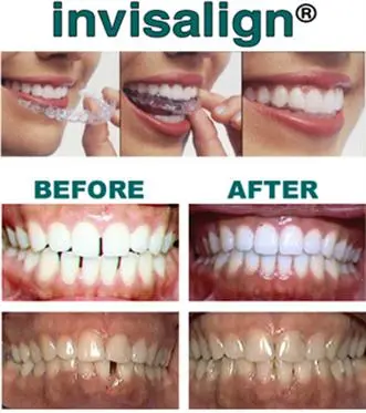 Clear Braces Wall Twp NJ  Straighten Teeth with Invisalign Clear Aligners